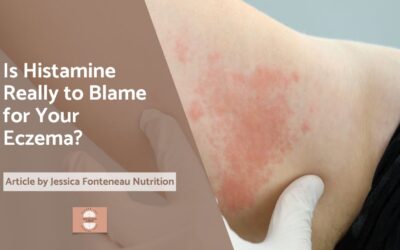 Is Histamine Really to Blame for Your Eczema?