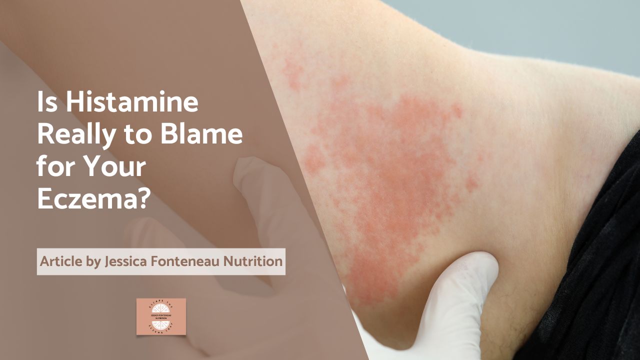 Is Histamine Really to Blame for Your Eczema?