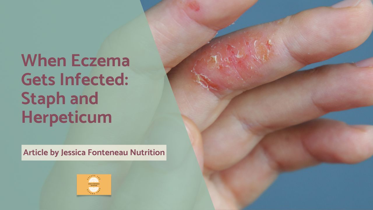 When Eczema Gets Infected Staph and Herpeticum