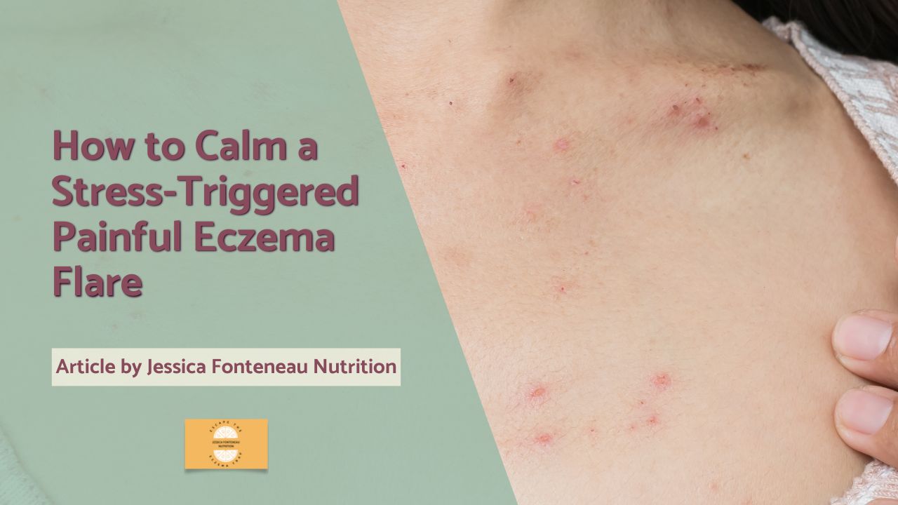 How to Calm a Stress Triggered Painful Eczema Flare
