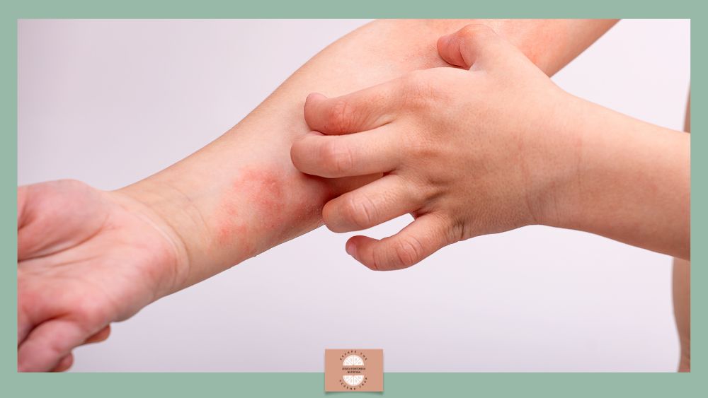 Identifying the Children Who Wont Grow Out of Eczema - Jessica Fonteneau Nutrition