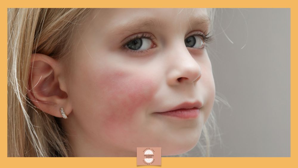 Identifying the Children Who Wont Grow Out of Eczema 3 - Jessica Fonteneau Nutrition