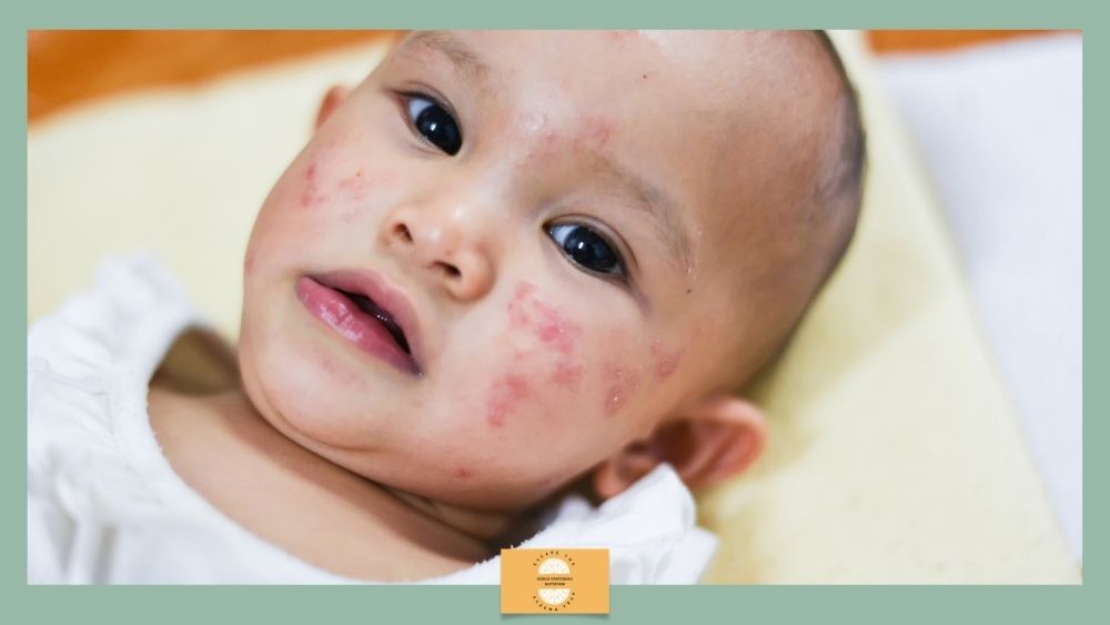 Identifying the Children Who Wont Grow Out of Eczema - Jessica Fonteneau Nutrition Identifying the Children Who Wont Grow Out of Eczema