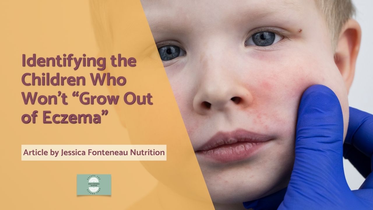 Identifying the Children Who Wont Grow Out of Eczema Identifying the Children Who Won’t “Grow Out of Eczema”