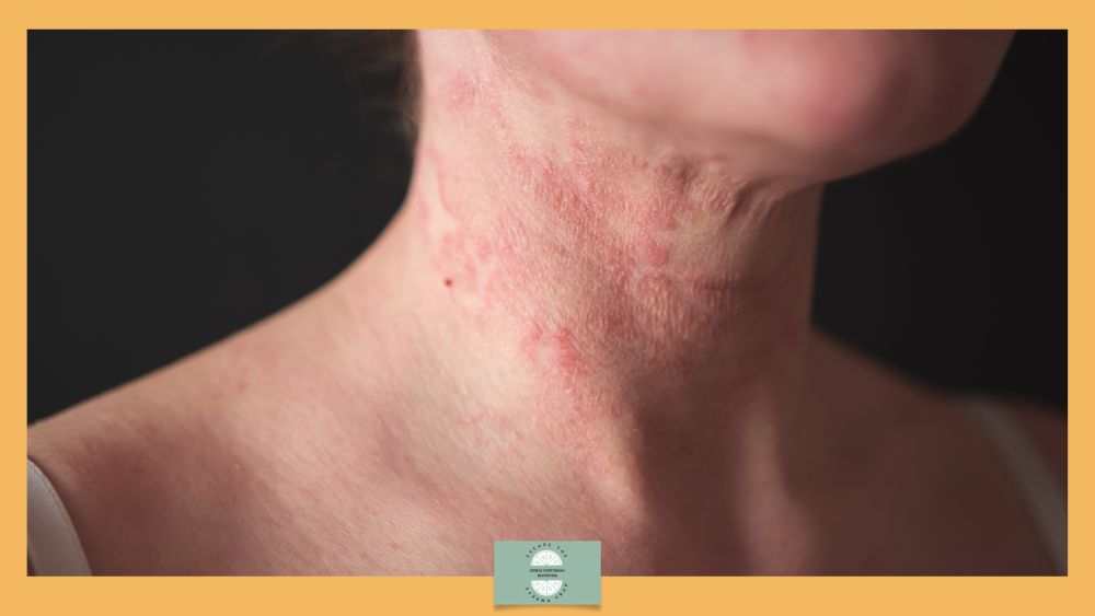 When your skin changes and nobody mentions the perimenopause - woman's neck with eczema visible.