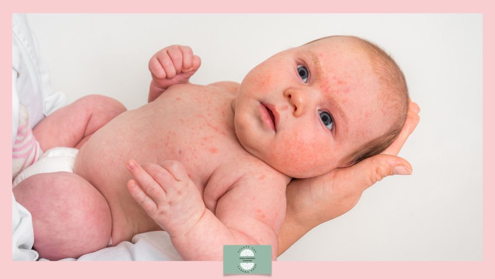 Newborn baby with red rashes on cheeks and body being cradled by a caregiver's hands against a pale pink background.