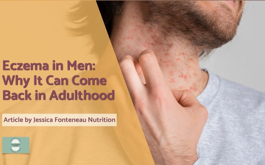 Eczema in Men: Why It Can Come Back in Adulthood