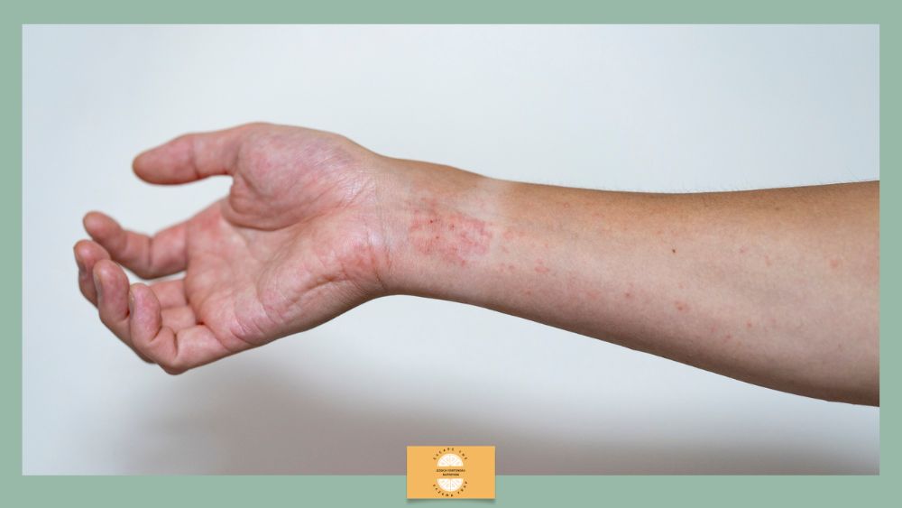Eczema in men - male arm with eczema visible.